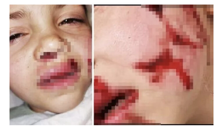Horrific pictures show girl’s bloody face after dog attacked her in garden