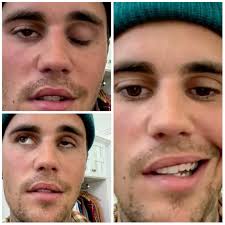 Justin Bieber cancels shows after half of face left paralysed by virus