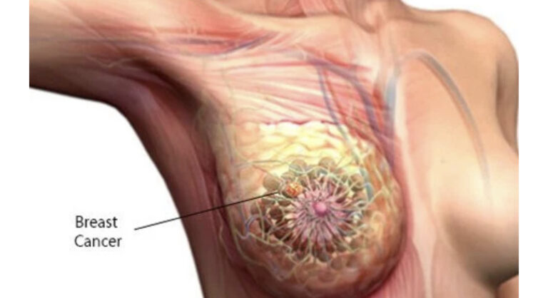 Breastfeeding, not breast sucking prevents breast cancer – Doctor 