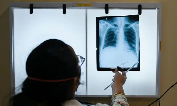 TB cases are on the rise globally first time in 20 years