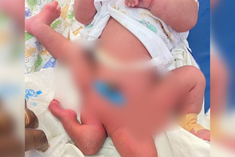 KATH: Medical Team Successfully Performs Surgery On Infant Born With Limb Malformation