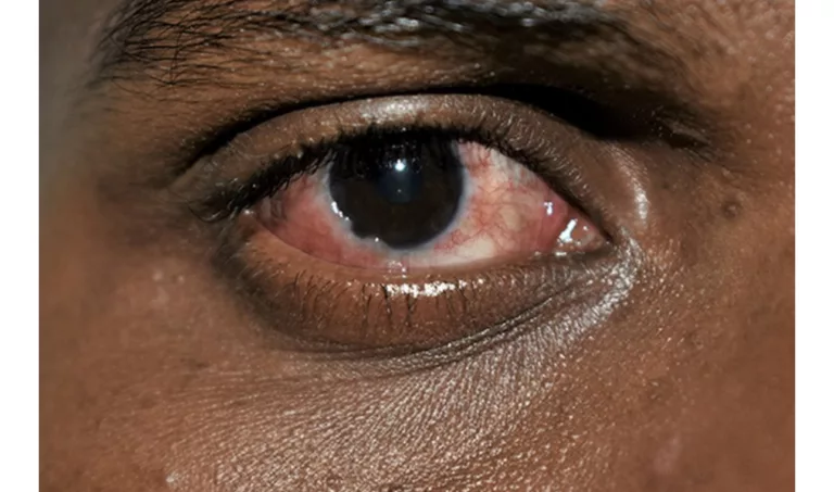 Ghana records surge in Apollo – Ghana Optometric Association