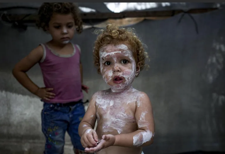 Skin diseases plunge on children in Gaza